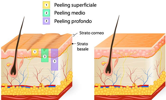 Peeling profondità