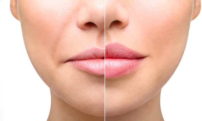 Filler labbra Foto Prima e Dopo