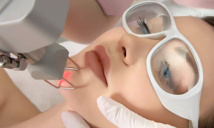 eliminare macchie viso laser costo