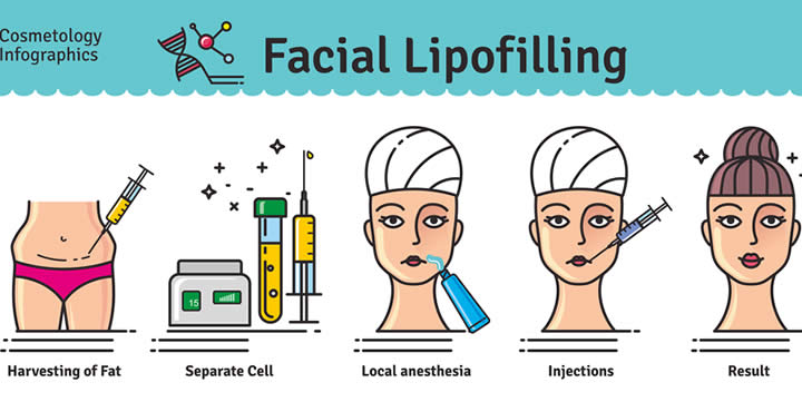 Lipofilling Infografica